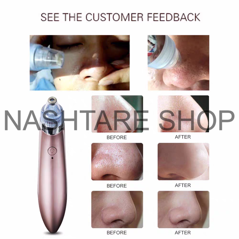Electric Blackhead Remover | جهاز شفط و إزالة الرؤوس السوداء